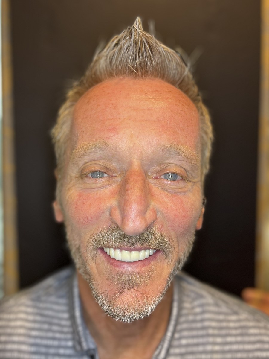The same patient after All-on-4 treatment, smiling with a full restored arch