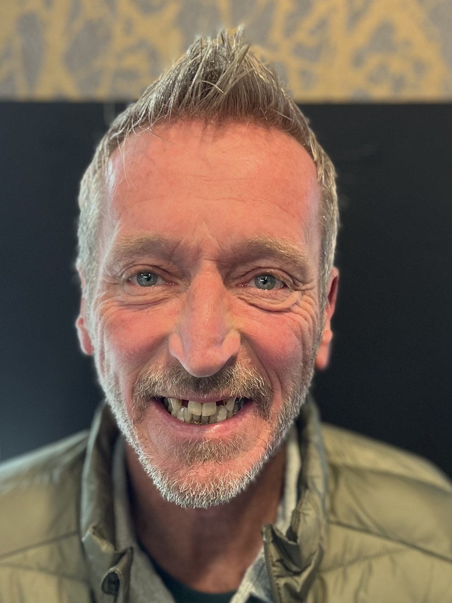 Patient before All-on-4 treatment, showing worn and shortened teeth