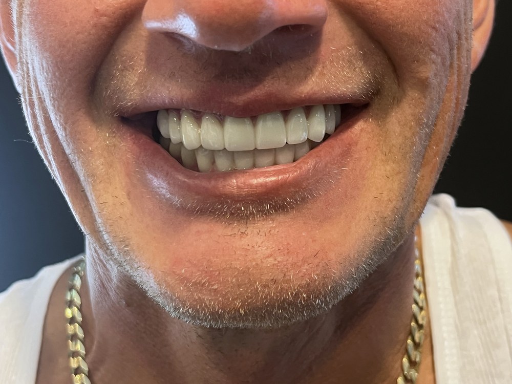 Close view after treatment, showing the finished fixed prosthesis