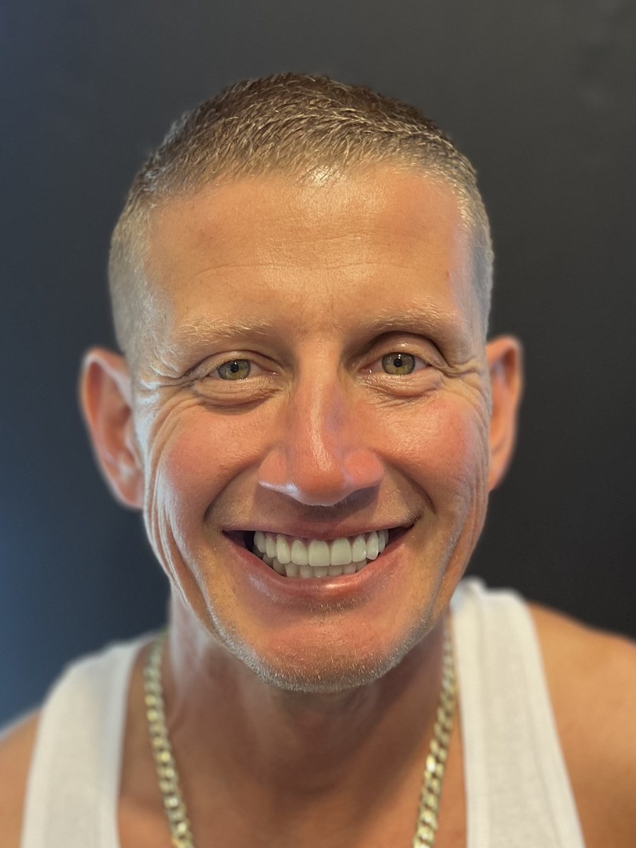 The same patient after full-arch implant treatment, smiling with a complete set of teeth