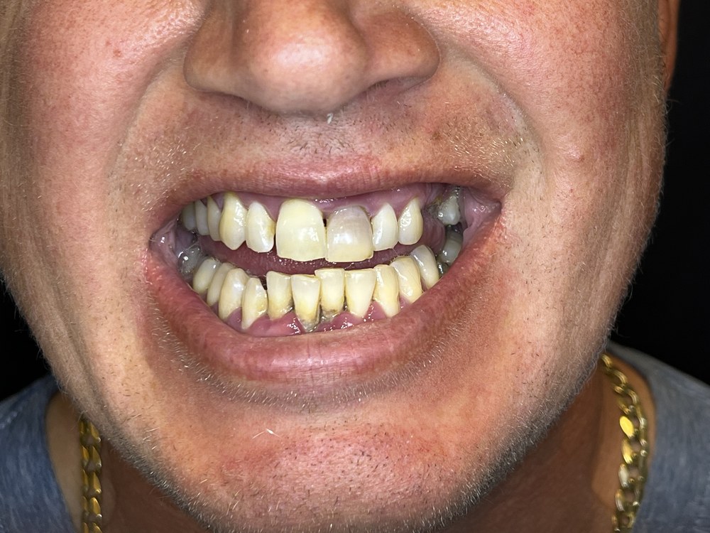 Close view before treatment, showing chipped, worn and heavily stained teeth