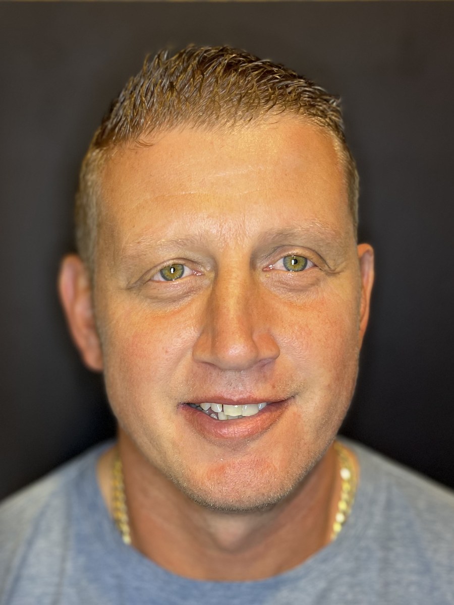 Patient before full-arch implant treatment, showing worn and damaged teeth